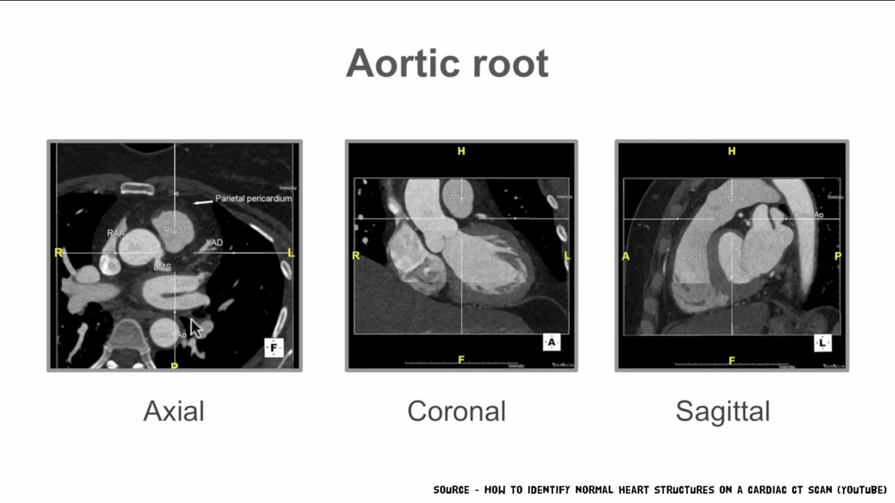 Cardiomyopathy Video